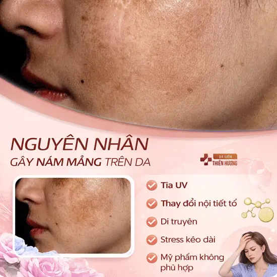 Nám Mảng Là Gì? Nguyên Nhân, Dấu Hiệu Nhận Biết & Cách Điều Trị