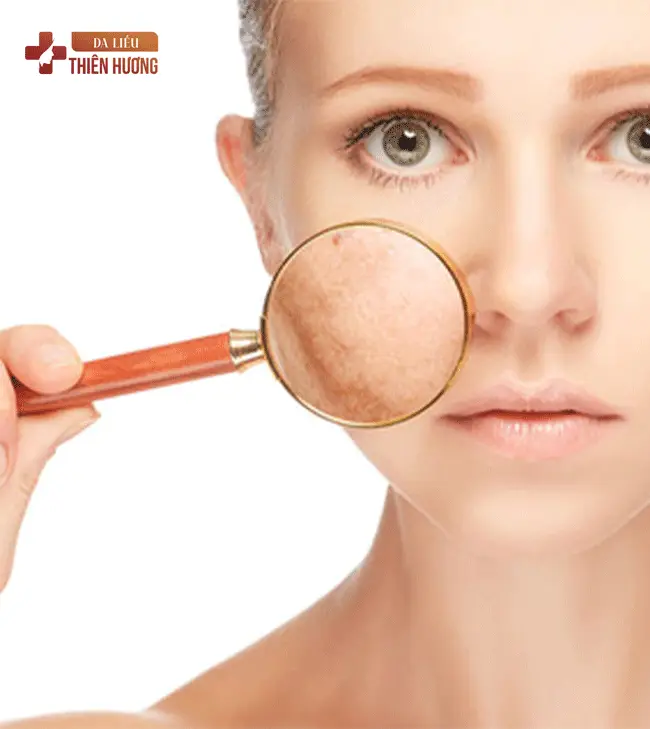 Nám Nội Tiết: Nguyên Nhân, Biểu Hiện & Phương Pháp Điều Trị
