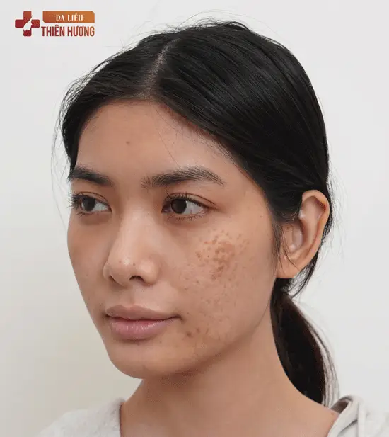 Nám Nội Tiết: Nguyên Nhân, Biểu Hiện & Phương Pháp Điều Trị