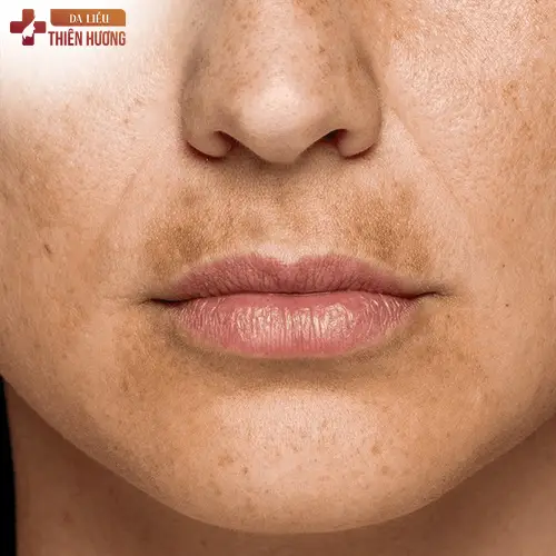 Nám râu là gì? Nguyên nhân, dấu hiệu nhận biết và cách điều trị hiệu quả