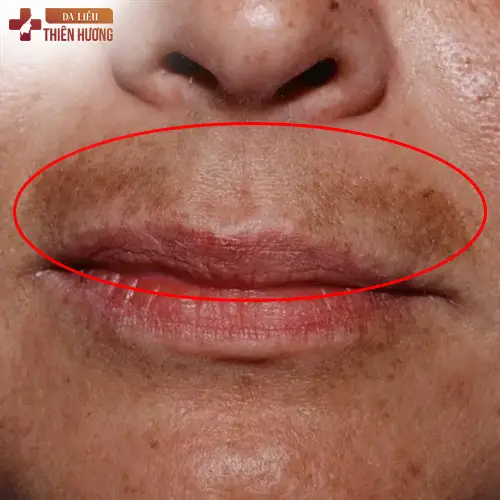 Nám râu là gì? Nguyên nhân, dấu hiệu nhận biết và cách điều trị hiệu quả