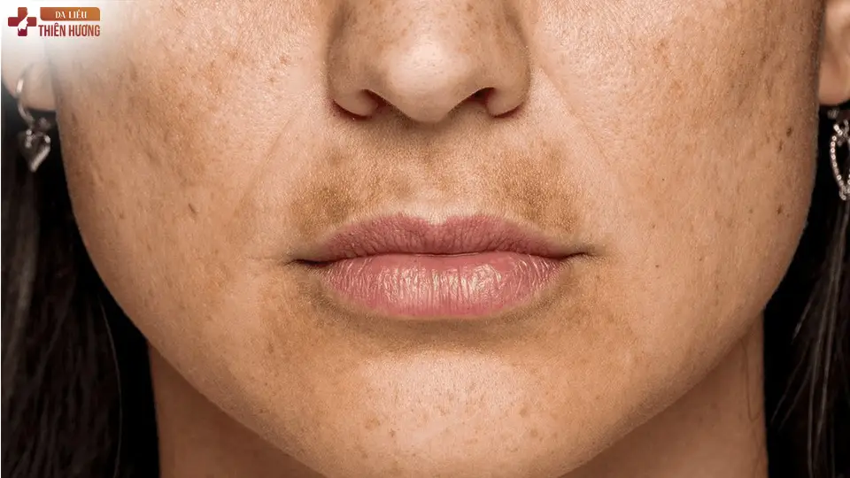 Nám râu là gì? Nguyên nhân, dấu hiệu nhận biết và cách điều trị hiệu quả