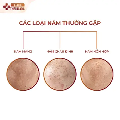 Nám, Tàn Nhang và Đồi Mồi: 5 Dấu Hiệu Phân Biệt Chính Xác & Cách Điều Trị Phù Hợp