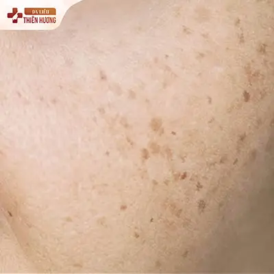 Nám, Tàn Nhang và Đồi Mồi: 5 Dấu Hiệu Phân Biệt Chính Xác & Cách Điều Trị Phù Hợp