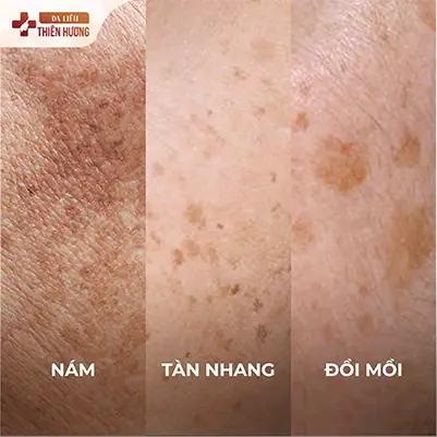 Nám, Tàn Nhang và Đồi Mồi: 5 Dấu Hiệu Phân Biệt Chính Xác & Cách Điều Trị Phù Hợp