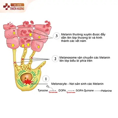 Nám, Tàn Nhang và Đồi Mồi: 5 Dấu Hiệu Phân Biệt Chính Xác & Cách Điều Trị Phù Hợp