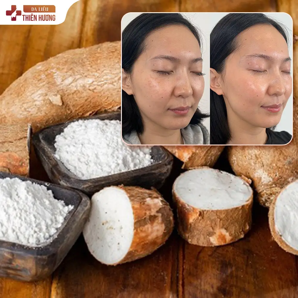 Bột Sắn Dây Có Trị Nám Được Không? Sự Thật Ít Ai Biết