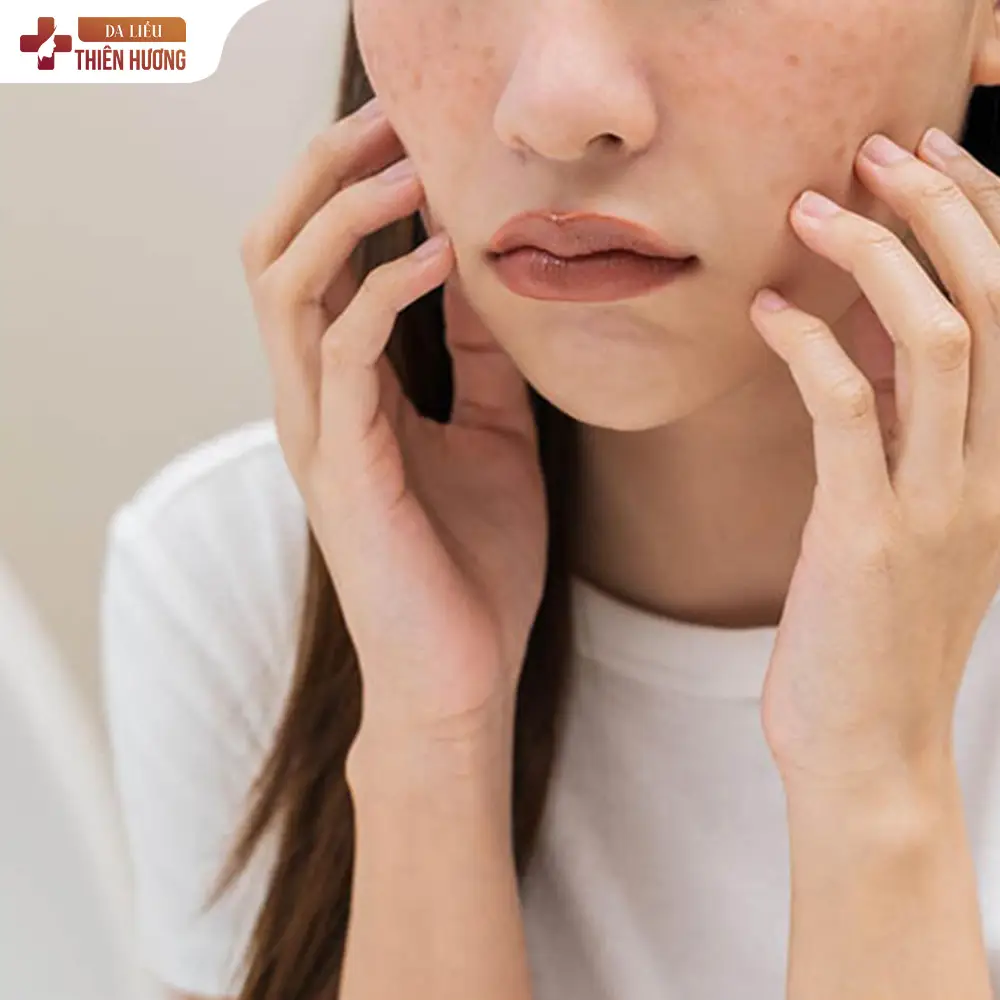 Bột Sắn Dây Có Trị Nám Được Không? Sự Thật Ít Ai Biết