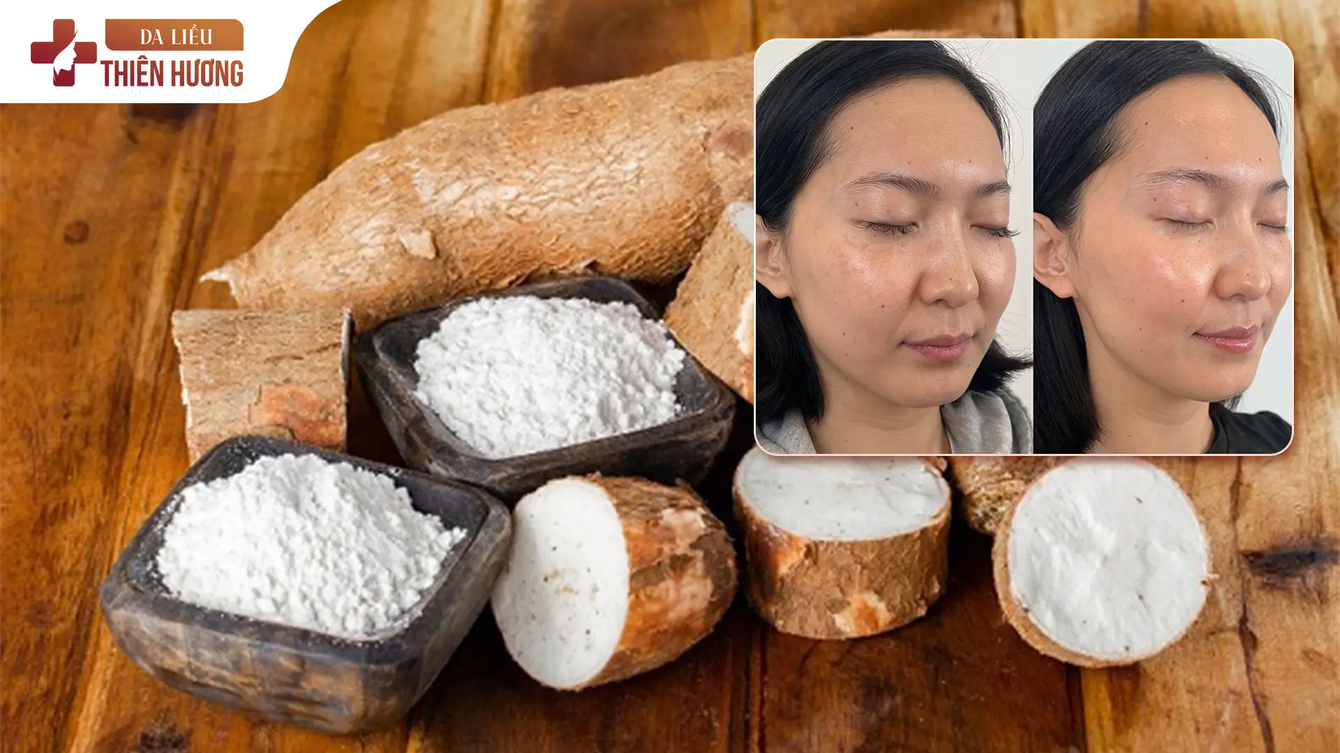 Bột Sắn Dây Có Trị Nám Được Không? Sự Thật Ít Ai Biết