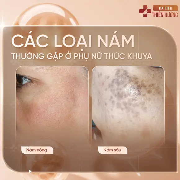 Thức Khuya Có Bị Nám Không? Nguyên Nhân & Mức Độ Ảnh Hưởng
