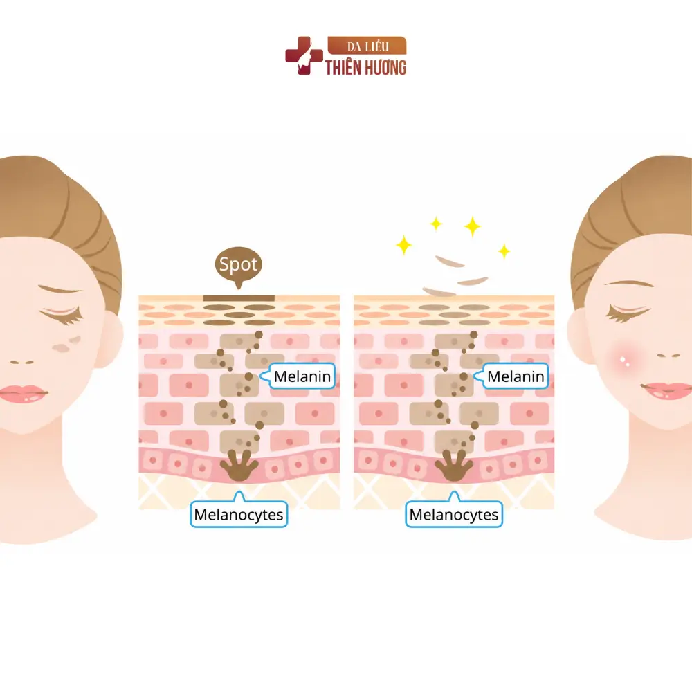 Cấu Trúc Da Nám: Melanocyte, Lớp Thượng Bì Và Cơ Chế Hình Thành Sắc Tố
