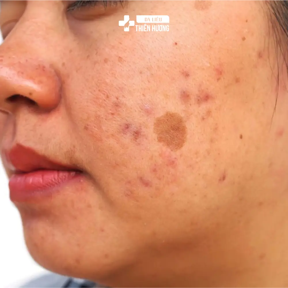 Cấu Trúc Da Nám: Melanocyte, Lớp Thượng Bì Và Cơ Chế Hình Thành Sắc Tố