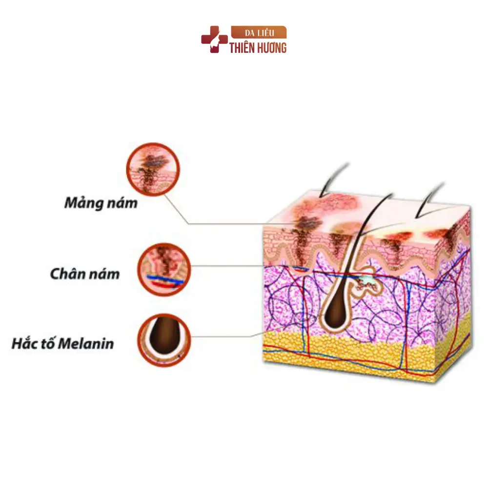 Cấu Trúc Da Nám: Melanocyte, Lớp Thượng Bì Và Cơ Chế Hình Thành Sắc Tố