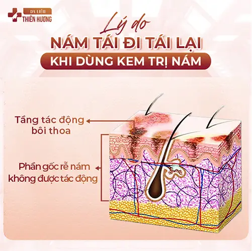 4 Công Nghệ Điều Trị Nám Hiệu Quả Hiện Nay Mà Bạn Nên Biết