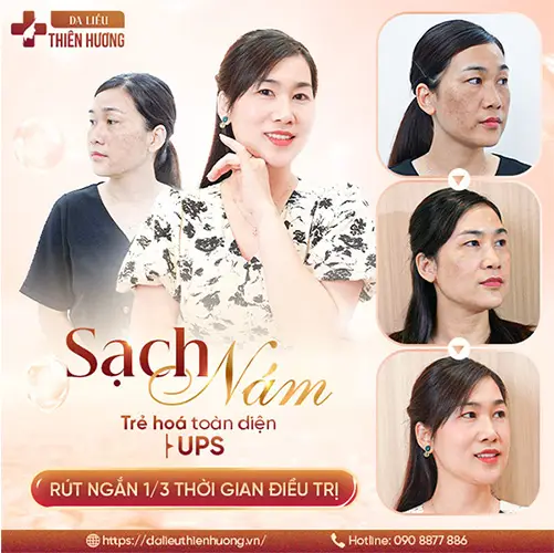 4 Công Nghệ Điều Trị Nám Hiệu Quả Hiện Nay Mà Bạn Nên Biết