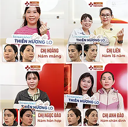 Công Nghệ Super White – Điều Trị Nám Không Xâm Lấn