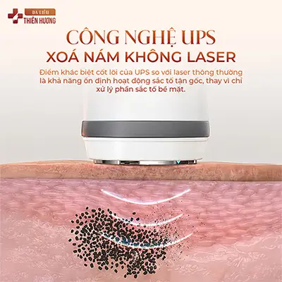 Công Nghệ Điều Trị Nám UPS – Hiệu Quả Nhanh, Không Xâm Lấn