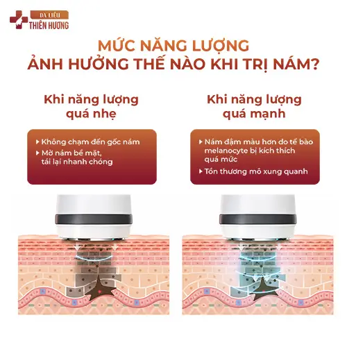 Công Nghệ Điều Trị Nám UPS – Hiệu Quả Nhanh, Không Xâm Lấn