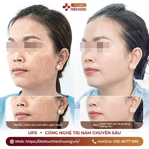 Công Nghệ Điều Trị Nám UPS – Hiệu Quả Nhanh, Không Xâm Lấn