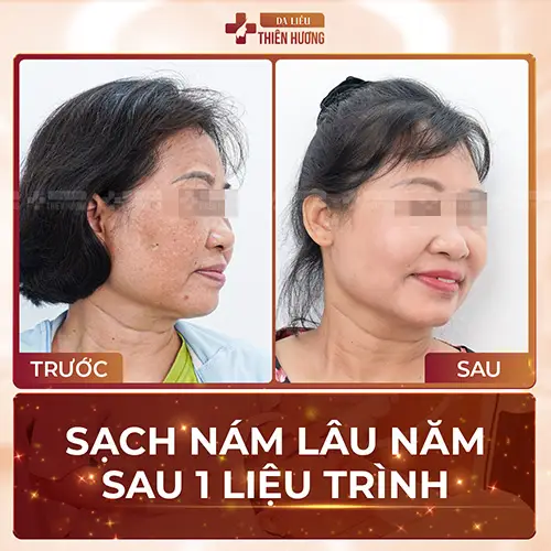 Công Nghệ Điều Trị Nám UPS – Hiệu Quả Nhanh, Không Xâm Lấn