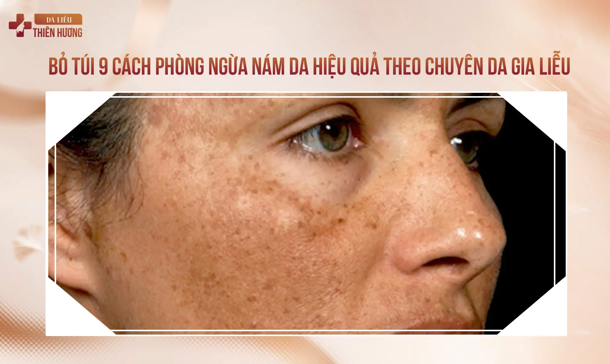 7 Nguyên Nhân Gây Nám Da Mặt Và Cơ Chế Hình Thành Sắc Tố Melanin