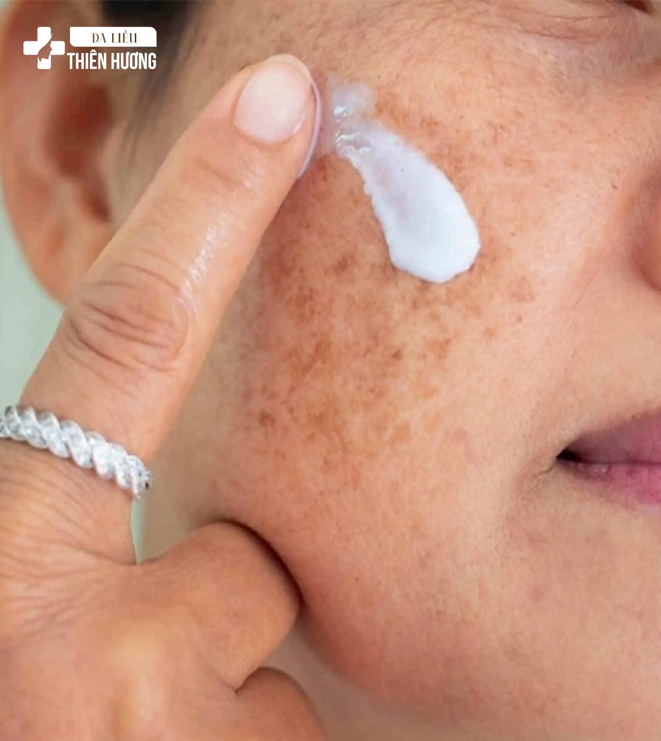 Điều Trị Nám Da: 7 Phương Pháp Hiệu Quả Được Bác Sĩ Tin Dùng