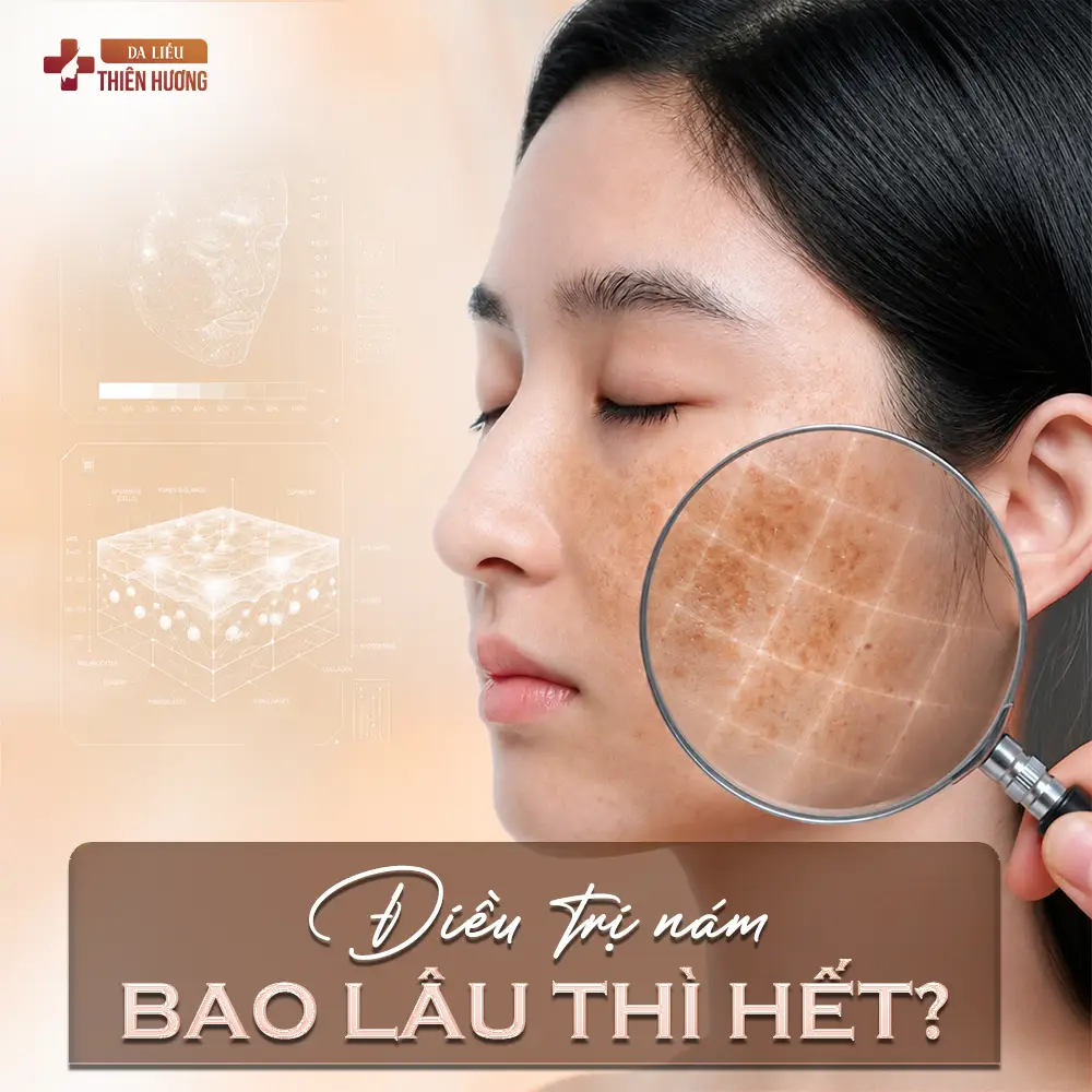 Điều Trị Nám Bao Lâu Thì Hết? Thời Gian Theo Từng Loại Nám