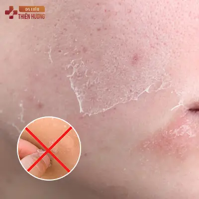 Cách Chăm Sóc Da Nám Đúng Cách: Nguyên Tắc & Quy Trình
