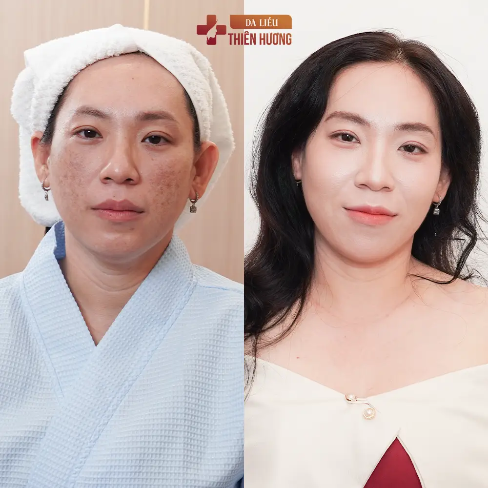 Công nghệ IPL trị nám da: Cơ chế, hiệu quả & ưu nhược điểm
