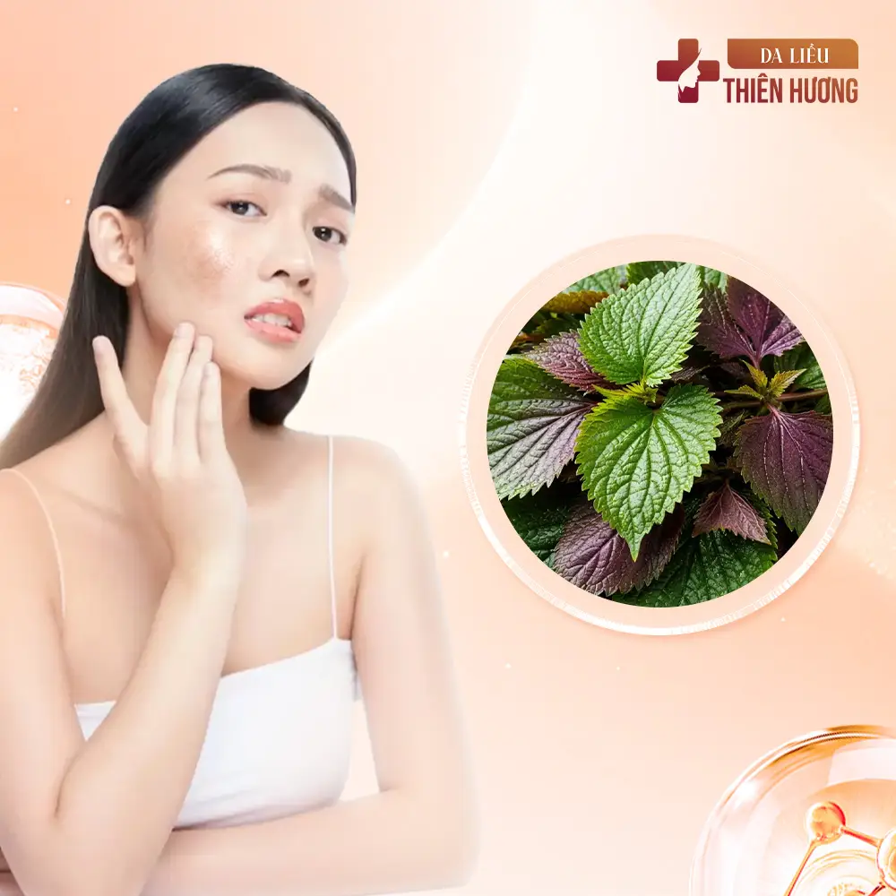 Lá Tía Tô Có Trị Nám Được Không? Hiệu Quả & Giới Hạn Cần Biết