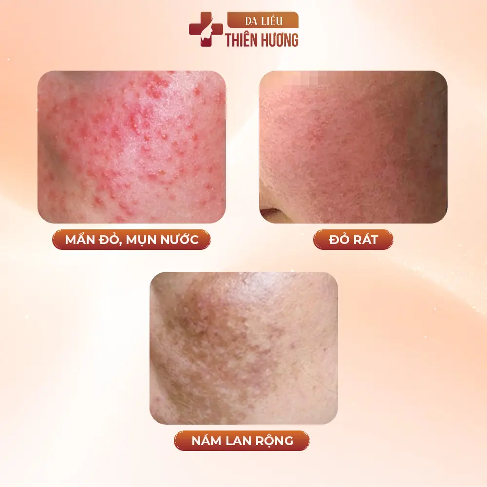 Lá Tía Tô Có Trị Nám Được Không? Hiệu Quả & Giới Hạn Cần Biết