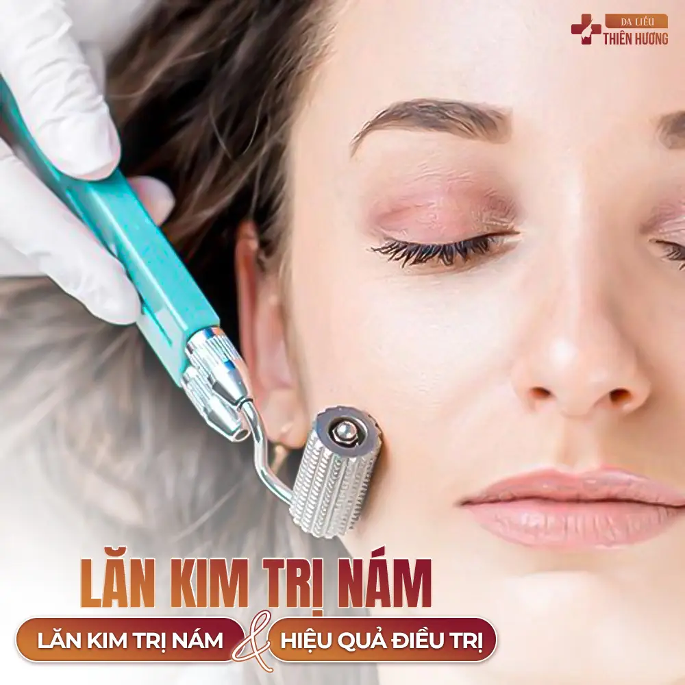 Lăn Kim Trị Nám: Ưu, Nhược Điểm & Hiệu Quả Điều Trị