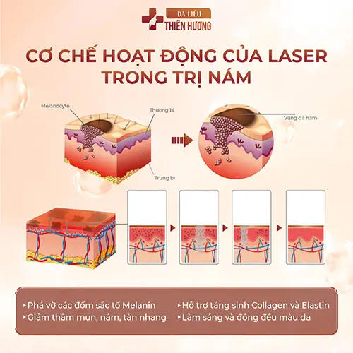 Bắn Laser Trị Nám Có Hiệu Quả Không? Chi Phí Bao Nhiêu?