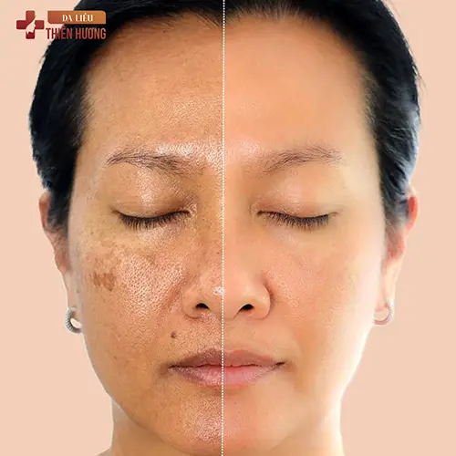 Bắn Laser Trị Nám Có Hiệu Quả Không? Chi Phí Bao Nhiêu?