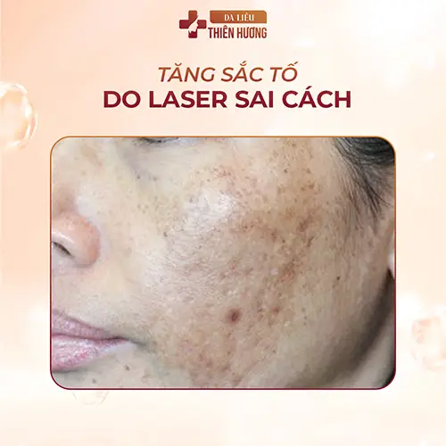 Bắn Laser Trị Nám Có Hiệu Quả Không? Chi Phí Bao Nhiêu?