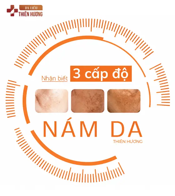 3 Mức Độ Nám Da: Phân Loại, Nhận Biết Và Phác Đồ Điều Trị Phù Hợp