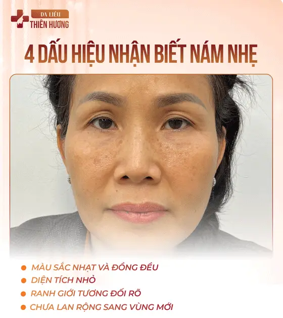 3 Mức Độ Nám Da: Phân Loại, Nhận Biết Và Phác Đồ Điều Trị Phù Hợp