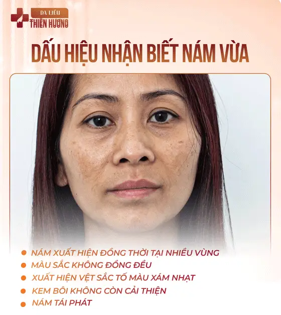 3 Mức Độ Nám Da: Phân Loại, Nhận Biết Và Phác Đồ Điều Trị Phù Hợp