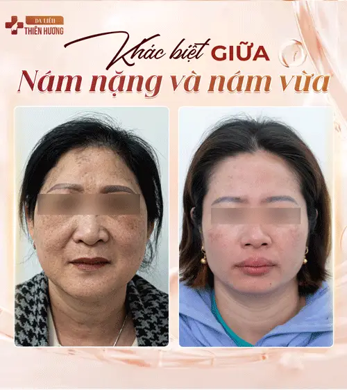 3 Mức Độ Nám Da: Phân Loại, Nhận Biết Và Phác Đồ Điều Trị Phù Hợp