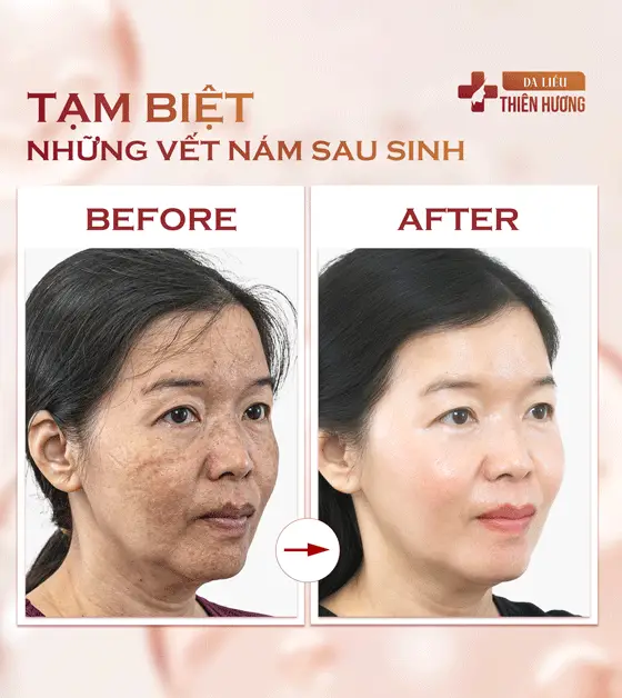 3 Mức Độ Nám Da: Phân Loại, Nhận Biết Và Phác Đồ Điều Trị Phù Hợp