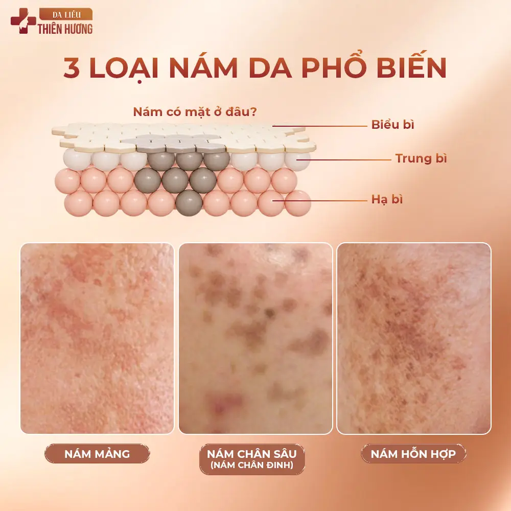 Nám Có Chữa Khỏi Hoàn Toàn Không? Sự Thật Từ Bác Sĩ Da Liễu