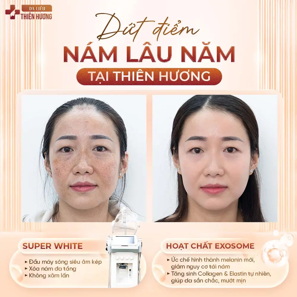 Nám Có Chữa Khỏi Hoàn Toàn Không? Sự Thật Từ Bác Sĩ Da Liễu