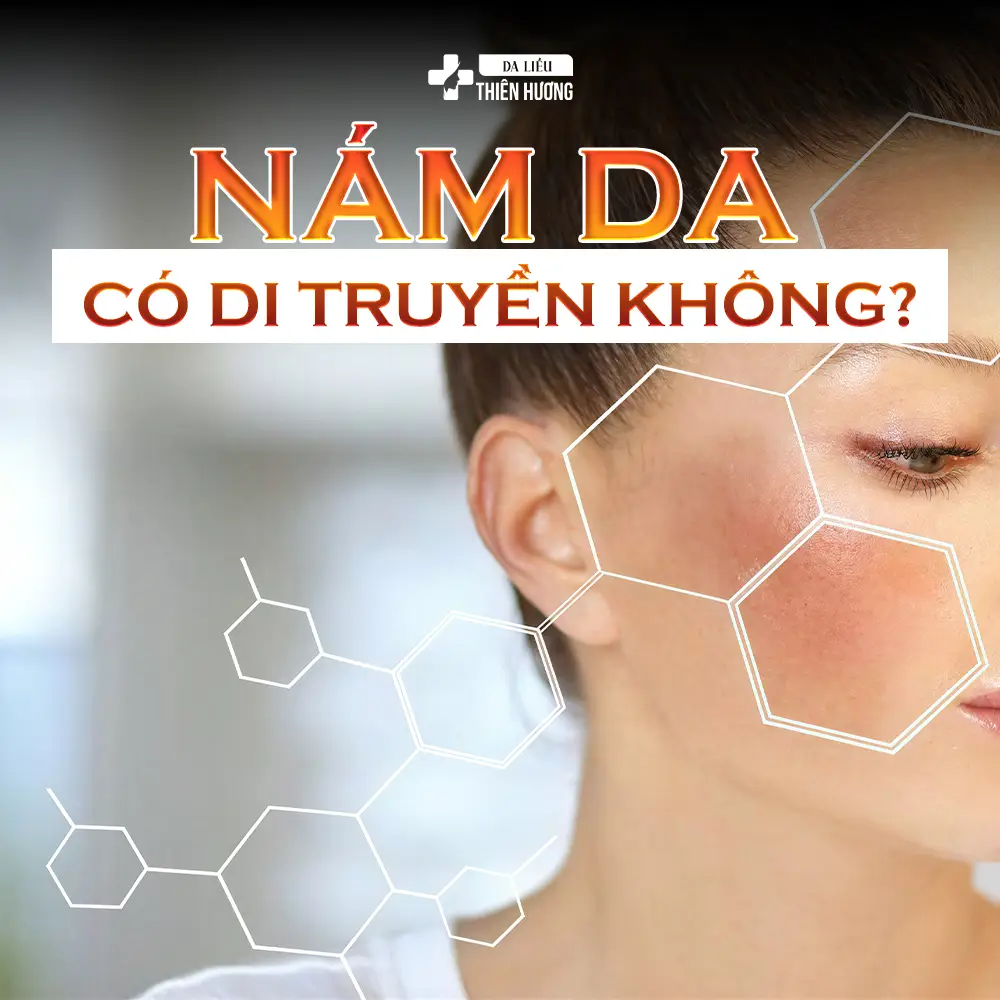 Nám Da Có Di Truyền Không? Bằng Chứng Khoa Học Đã Xác Thực