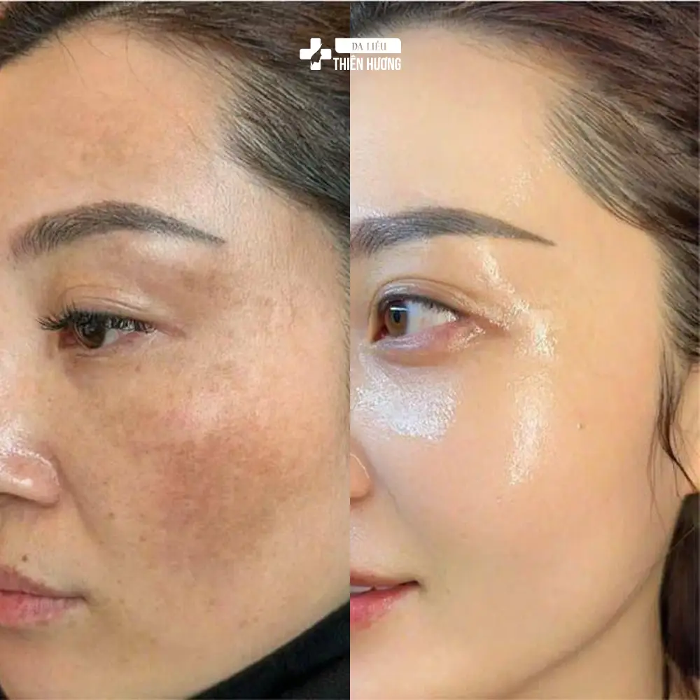 Nám Da Có Di Truyền Không? Bằng Chứng Khoa Học Đã Xác Thực