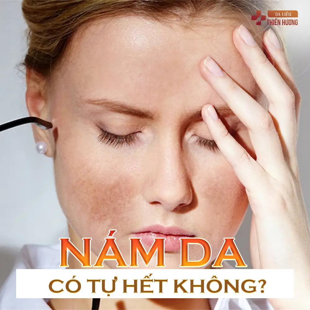 Nám Da Có Tự Khỏi Không? Câu Trả Lời Từ BS Thiên Hương