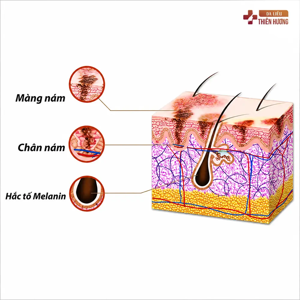 Nám Da Có Tự Khỏi Không? Câu Trả Lời Từ BS Thiên Hương