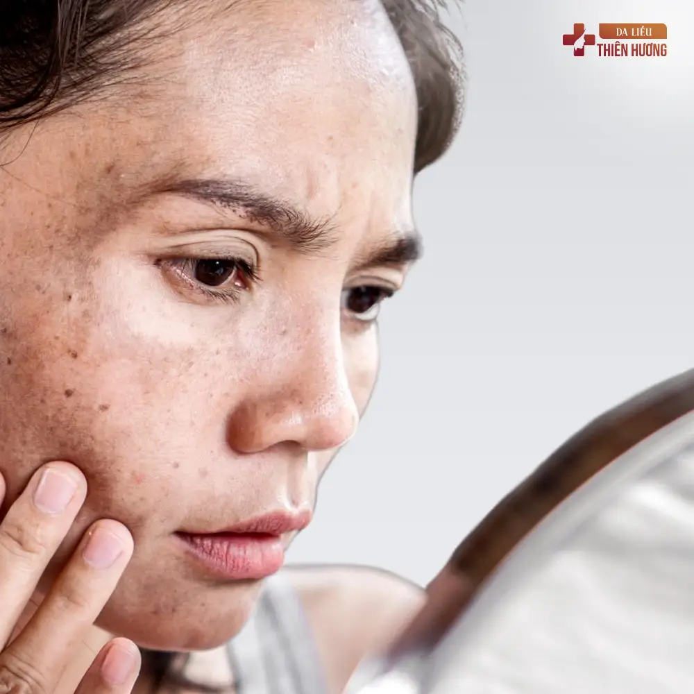 Nám Da Có Tự Khỏi Không? Câu Trả Lời Từ BS Thiên Hương