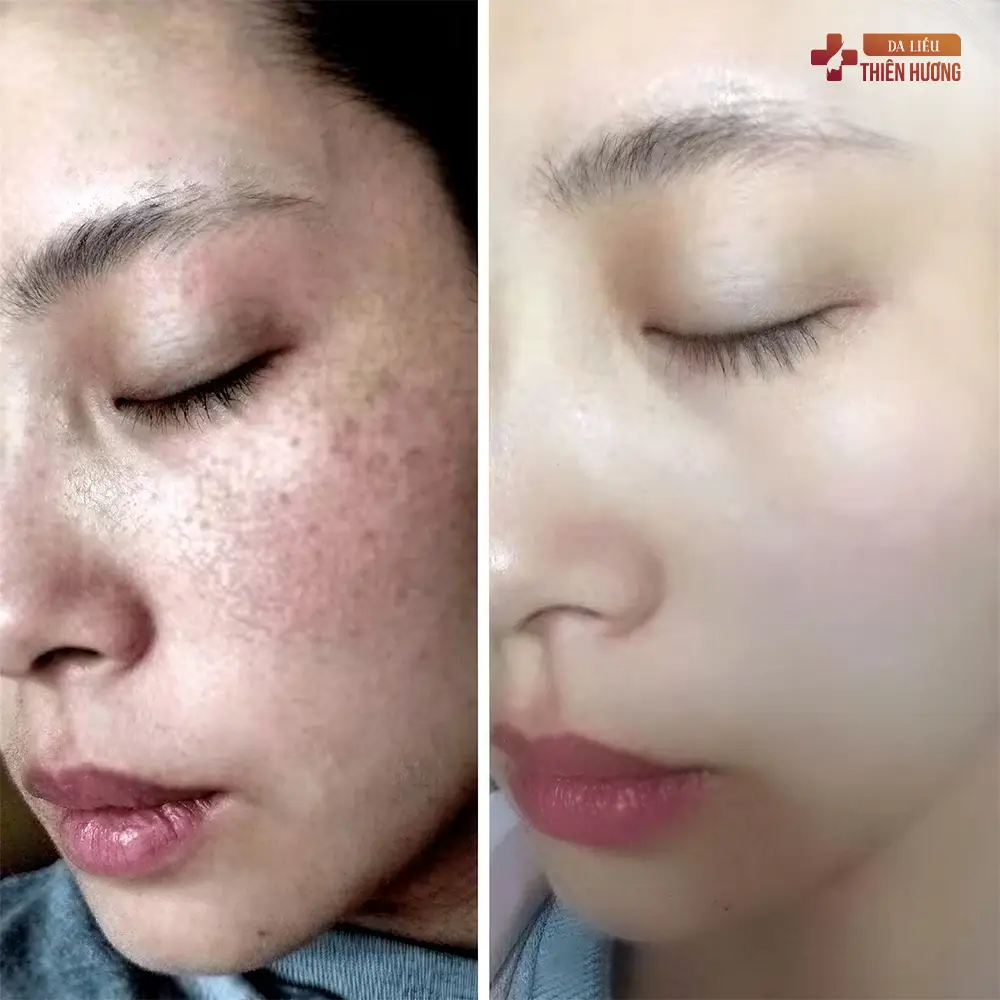 Nám Da Có Tự Khỏi Không? Câu Trả Lời Từ BS Thiên Hương