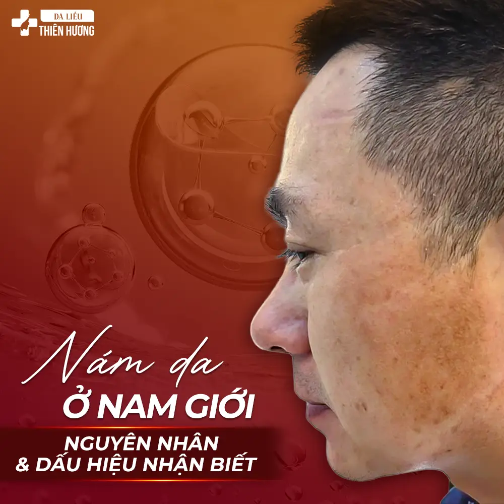 Nám Da Ở Nam Giới: Nguyên Nhân, Dấu Hiệu Nhận Biết & Phương Pháp Điều Trị Hiệu Quả