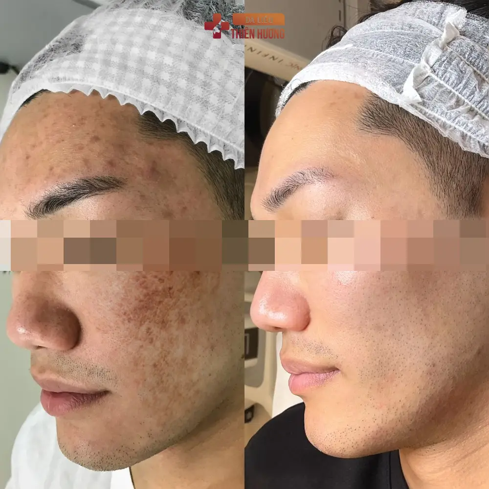 Nám Da Ở Nam Giới: Nguyên Nhân, Dấu Hiệu Nhận Biết & Phương Pháp Điều Trị Hiệu Quả